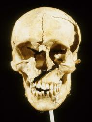 Image of a damaged skull