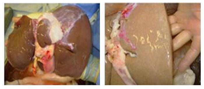 Comparison of healthy liver on left with poor liver on right